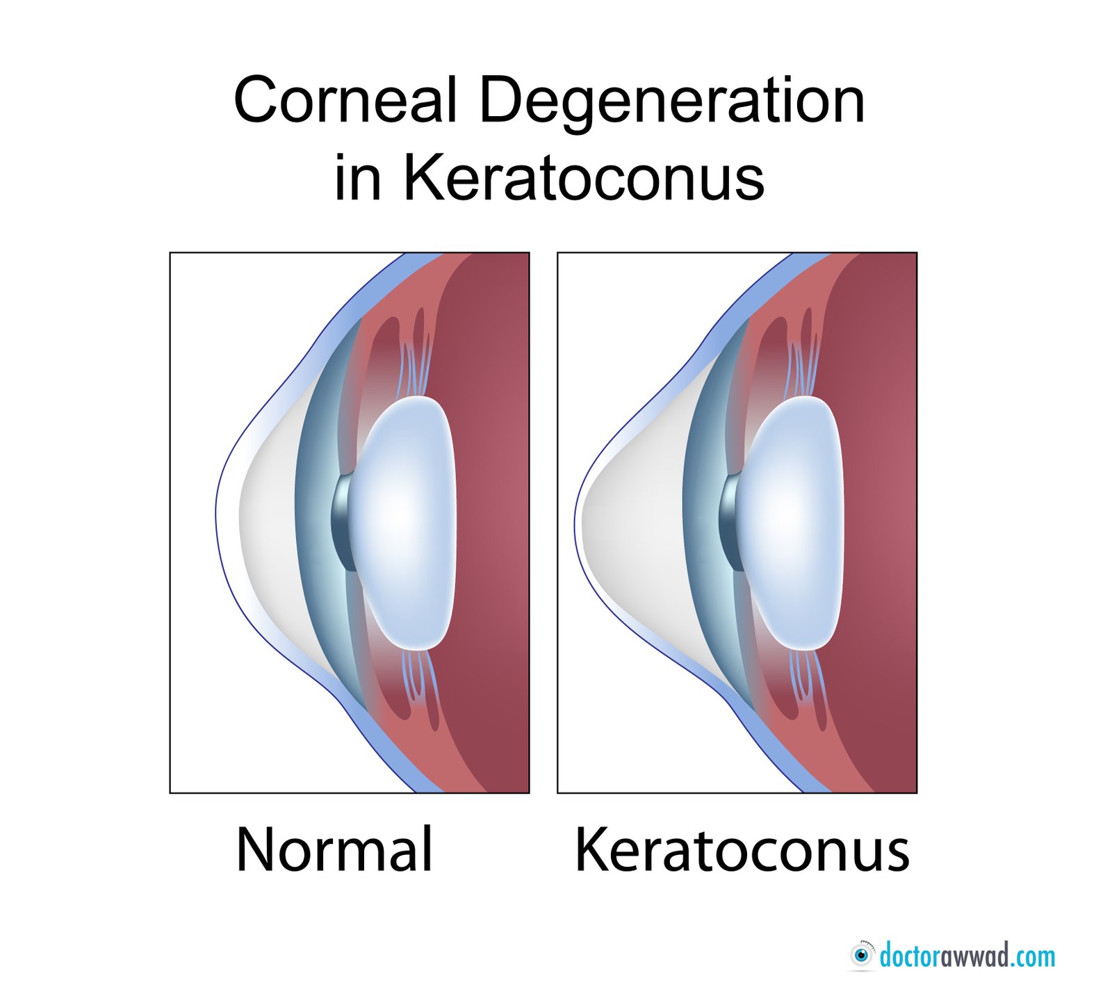 Keratoconus Overview Dr Shady Awwad, eye surgeon at AUBMC